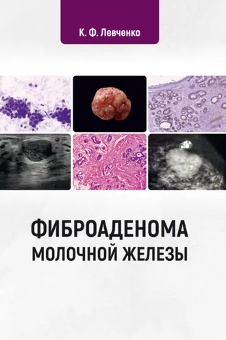 Обложка книги «Фиброаденома молочной железы»